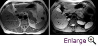 Adrenal Tumour