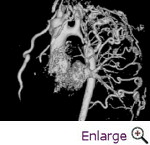 Coarctation of the Aorta