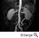 Renal Stenosis