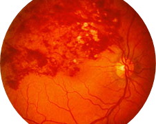 Thickening of blood vessels in eye